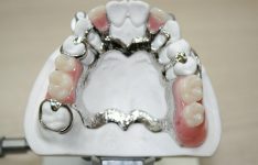 Cast partial Denture