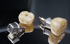 Posterior,Implant,Crown,With,Custom,Abutment