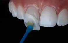 DentalVeneers-ezgif.com-png-to-webp-converter-1-e1715922275825