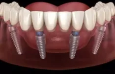 Full Mouth Implant Prosthetics