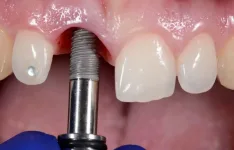 Implant Surgery