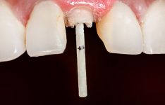 Post And Core