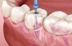 root-canal-procedure